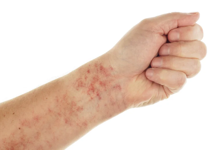 blood cancer symptoms