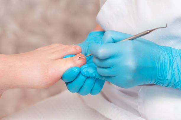 Ingrown nails